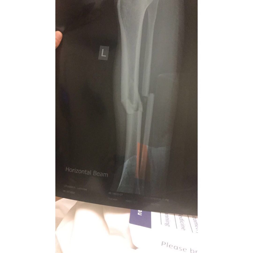 Crummer Broken Leg Crummer Broken Leg