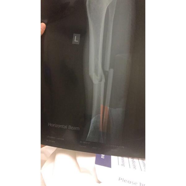 Crummer Broken Leg